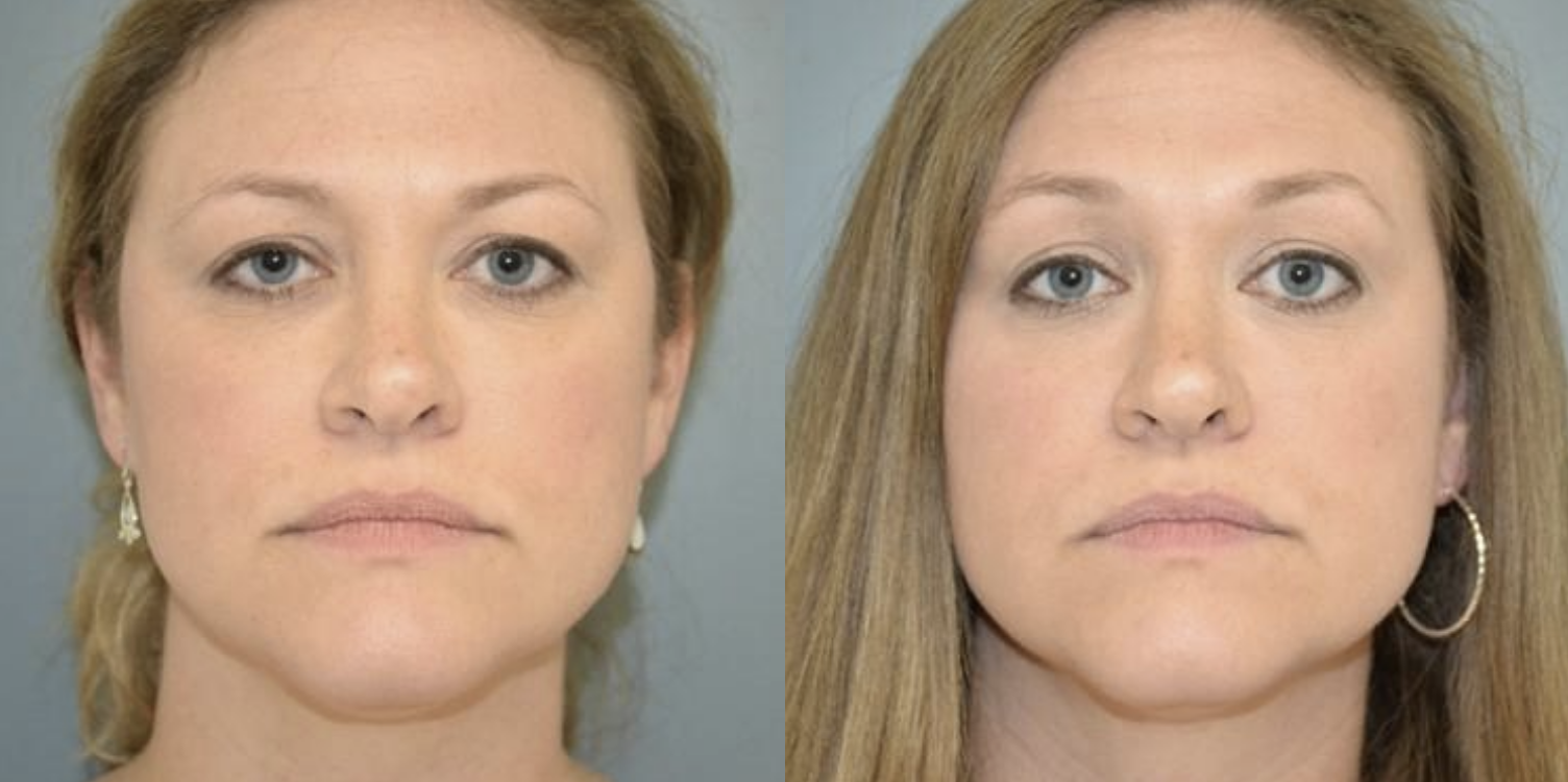 West End Facial Plastic Surgery otoplasty result — Richmond, VA