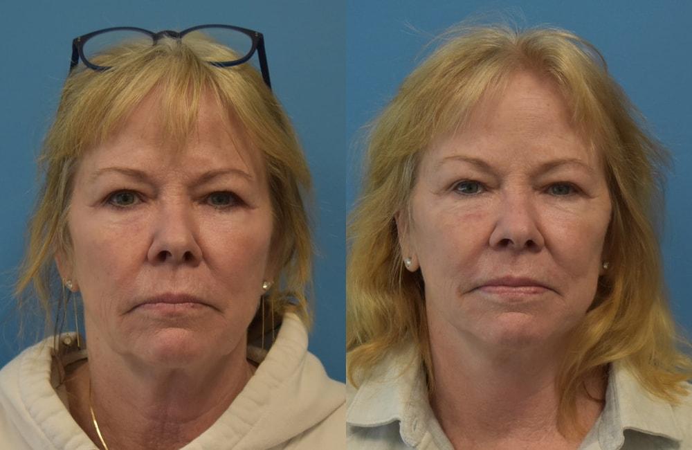 West End Facial Plastic Surgery facelift result — Richmond, VA