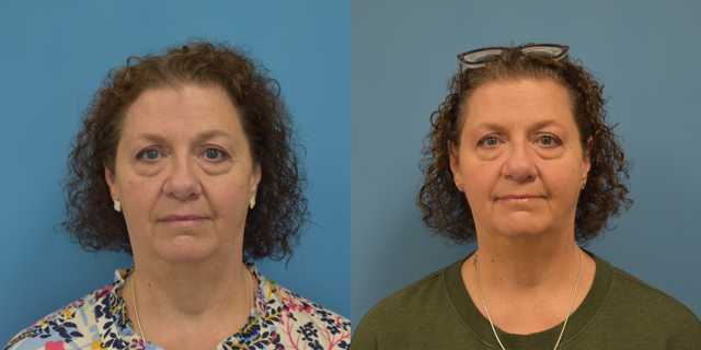 Rhinoplasty result at West End Facial Plastic Surgery in Richmond, VA