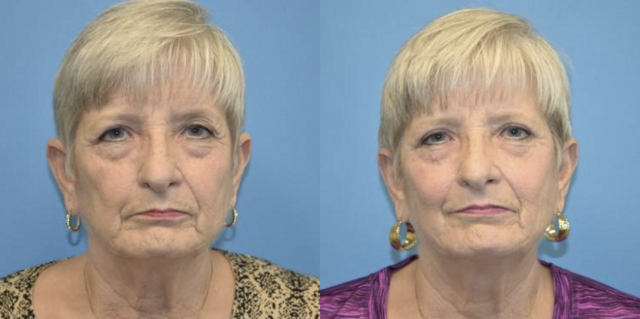 Blepharoplasty result at West End Facial Plastic Surgery in Richmond, VA