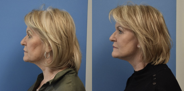 Neck Lift result at West End Facial Plastic Surgery in Richmond, VA