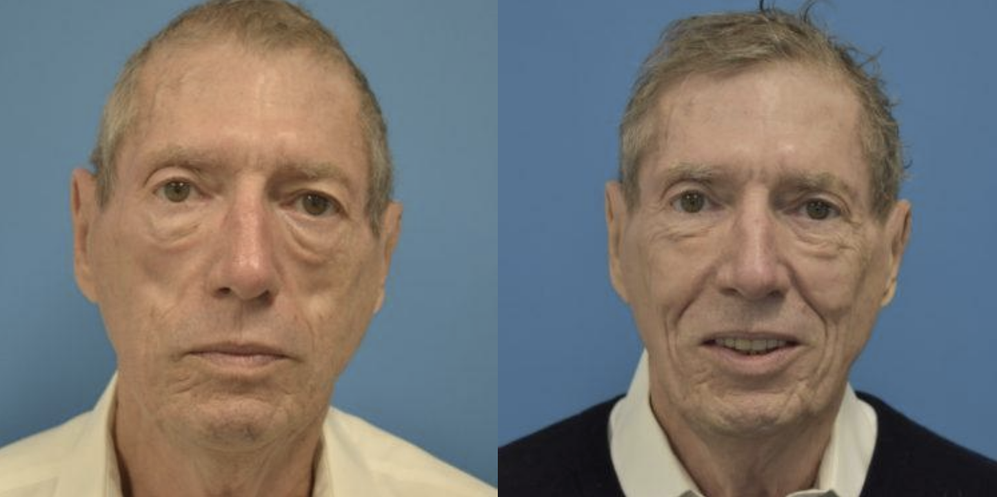 West End Facial Plastic Surgery otoplasty result — Richmond, VA