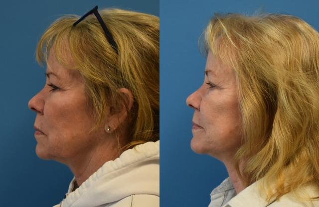 Facelift result at West End Facial Plastic Surgery in Richmond, VA