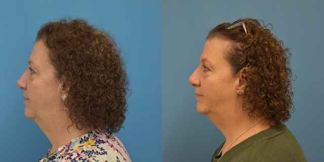 Rhinoplasty result at West End Facial Plastic Surgery in Richmond, VA