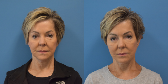 Neck Lift result at West End Facial Plastic Surgery in Richmond, VA