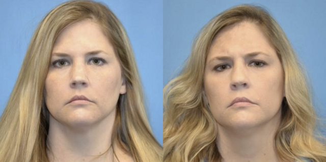 Rhinoplasty result at West End Facial Plastic Surgery in Richmond, VA