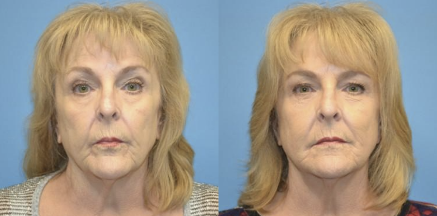 West End Facial Plastic Surgery otoplasty result — Richmond, VA