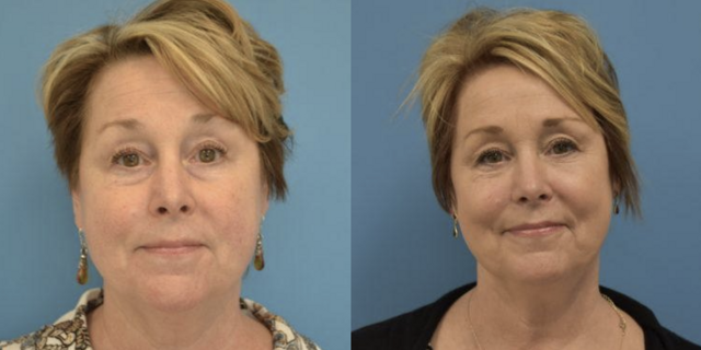 Neck Lift result at West End Facial Plastic Surgery in Richmond, VA