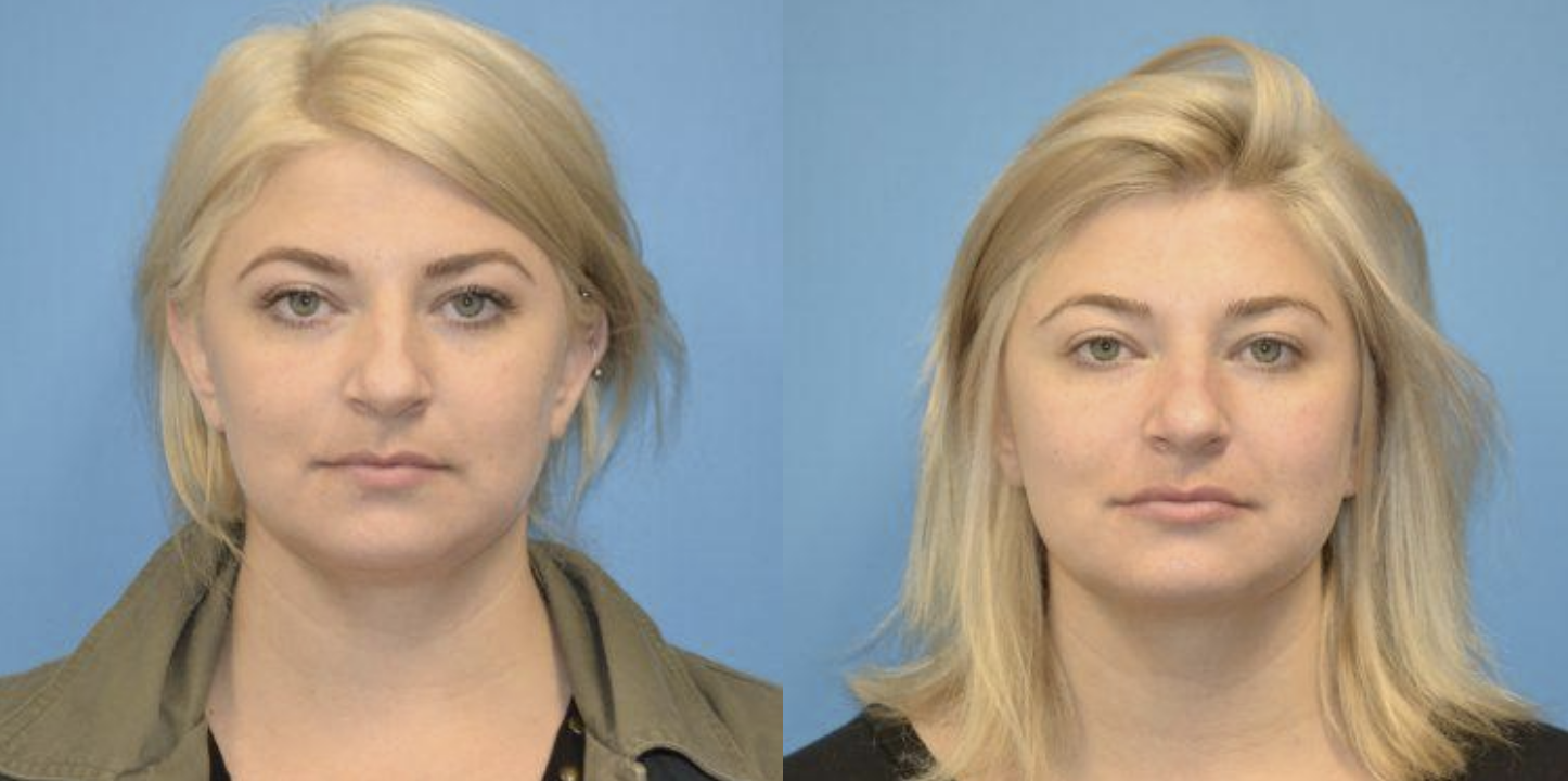 West End Facial Plastic Surgery otoplasty result — Richmond, VA