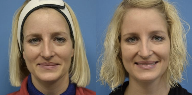 Botox result at West End Facial Plastic Surgery in Richmond, VA