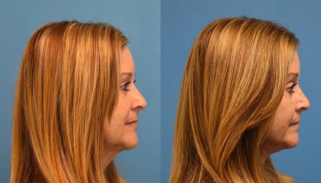 Facelift result at West End Facial Plastic Surgery in Richmond, VA