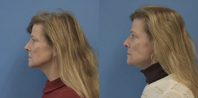Facelift result at West End Facial Plastic Surgery in Richmond, VA