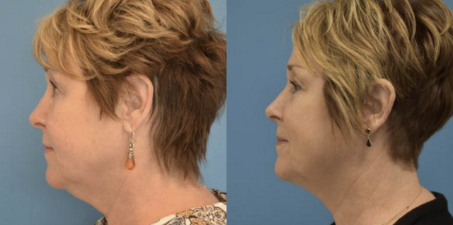Neck Lift result at West End Facial Plastic Surgery in Richmond, VA