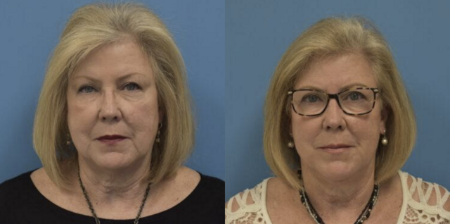 Neck Lift result at West End Facial Plastic Surgery in Richmond, VA