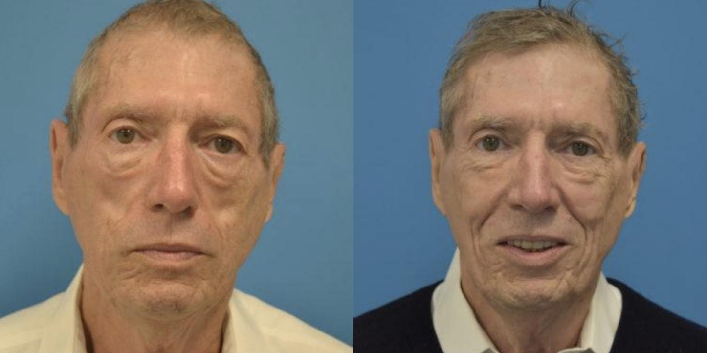 West End Facial Plastic Surgery eyelid lift result — Richmond, VA