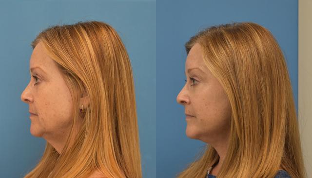 Facelift result at West End Facial Plastic Surgery in Richmond, VA