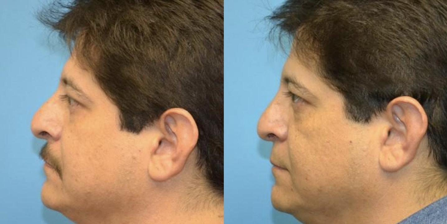West End Facial Plastic Surgery rhinoplasty result — Richmond, VA