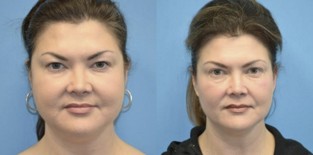 Blepharoplasty result at West End Facial Plastic Surgery in Richmond, VA
