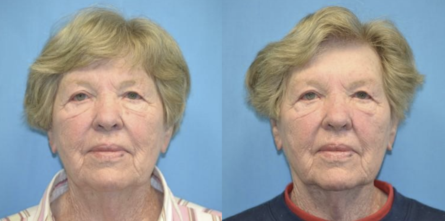 West End Facial Plastic Surgery otoplasty result — Richmond, VA