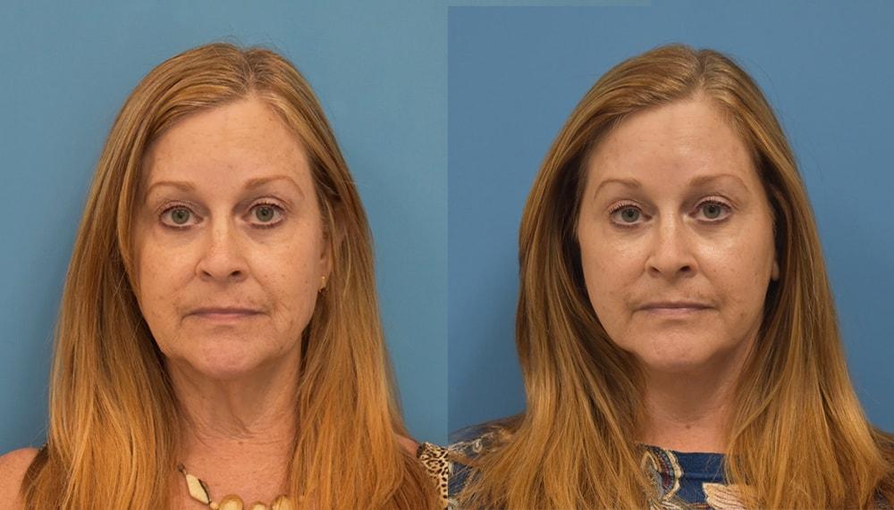 West End Facial Plastic Surgery facelift result — Richmond, VA