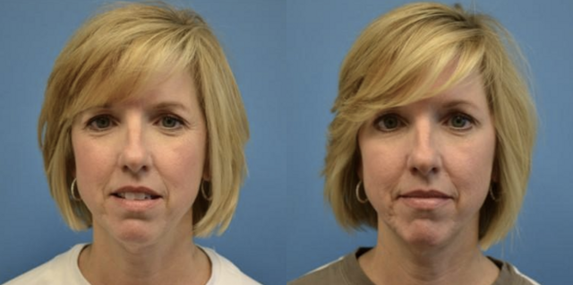 Botox result at West End Facial Plastic Surgery in Richmond, VA