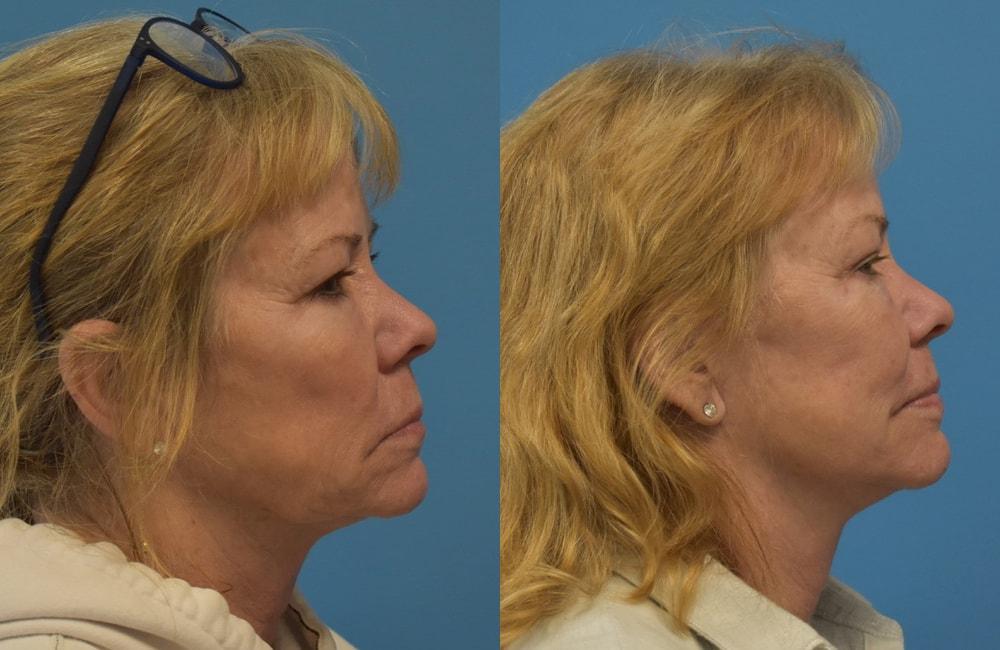 West End Facial Plastic Surgery facelift result — Richmond, VA