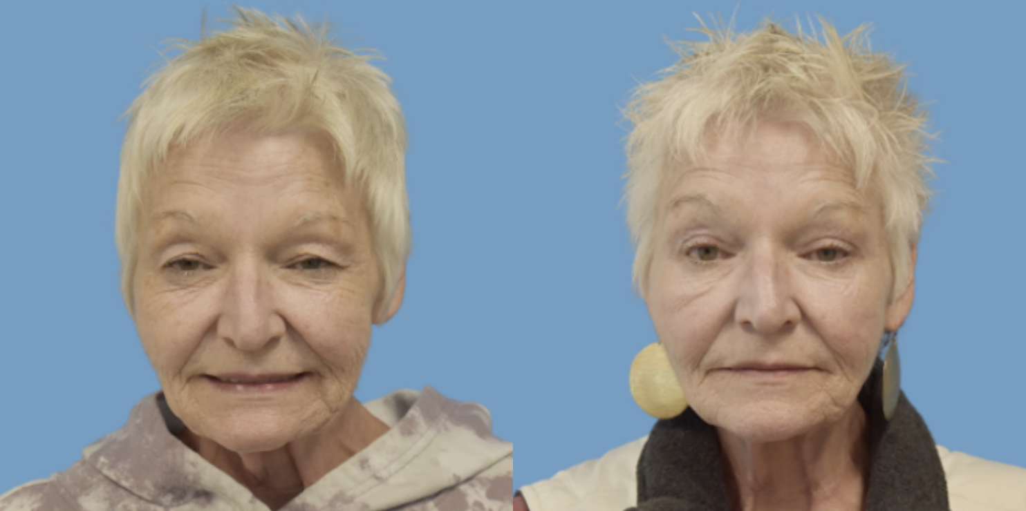 West End Facial Plastic Surgery eyelid lift result — Richmond, VA