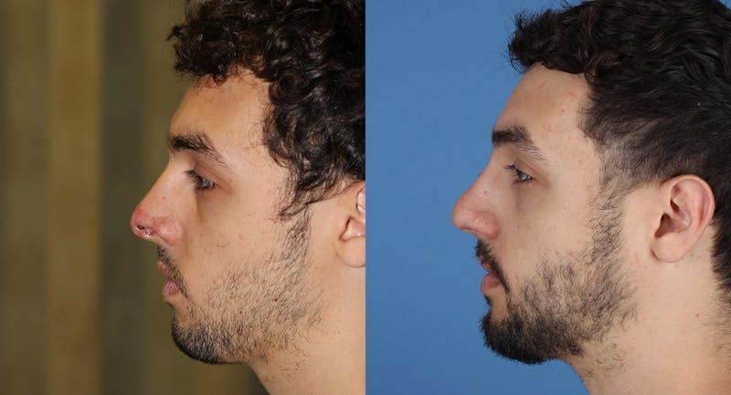 Andre Panossian, MD, Plastic Surgery rhinoplasty result — Pasadena, CA