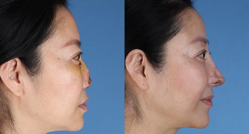 Andre Panossian, MD, Plastic Surgery rhinoplasty result — Pasadena, CA