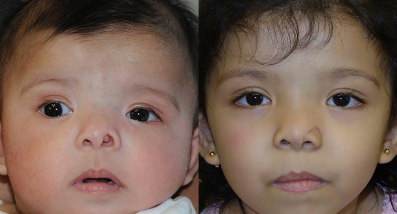 Andre Panossian, MD, Plastic Surgery rhinoplasty result — Pasadena, CA
