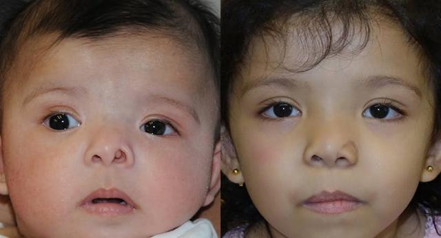 Rhinoplasty result at Andre Panossian, MD, Plastic Surgery in Pasadena, CA