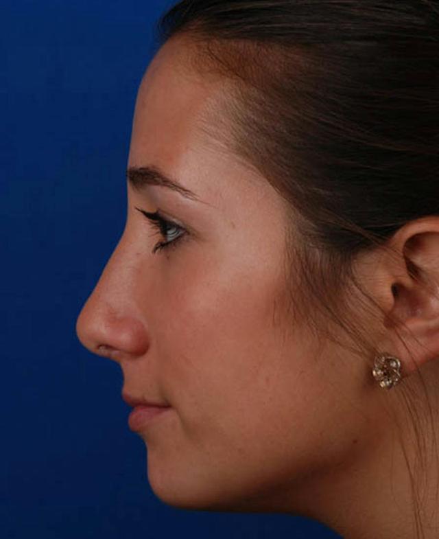 Rhinoplasty after at Marcus Medical in Los Angeles, CA