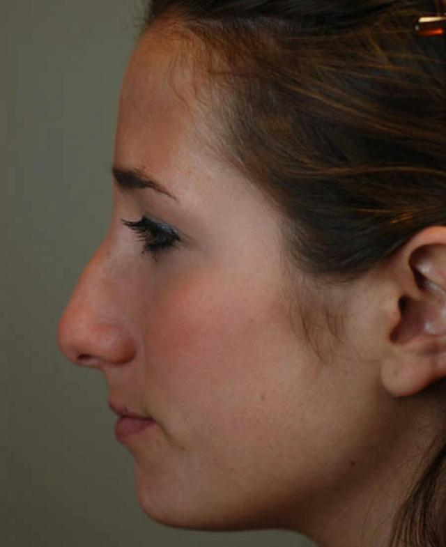 Rhinoplasty before at Marcus Medical in Los Angeles, CA