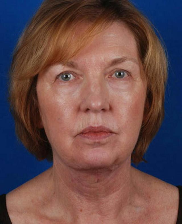 Facelift after at Marcus Medical in Los Angeles, CA