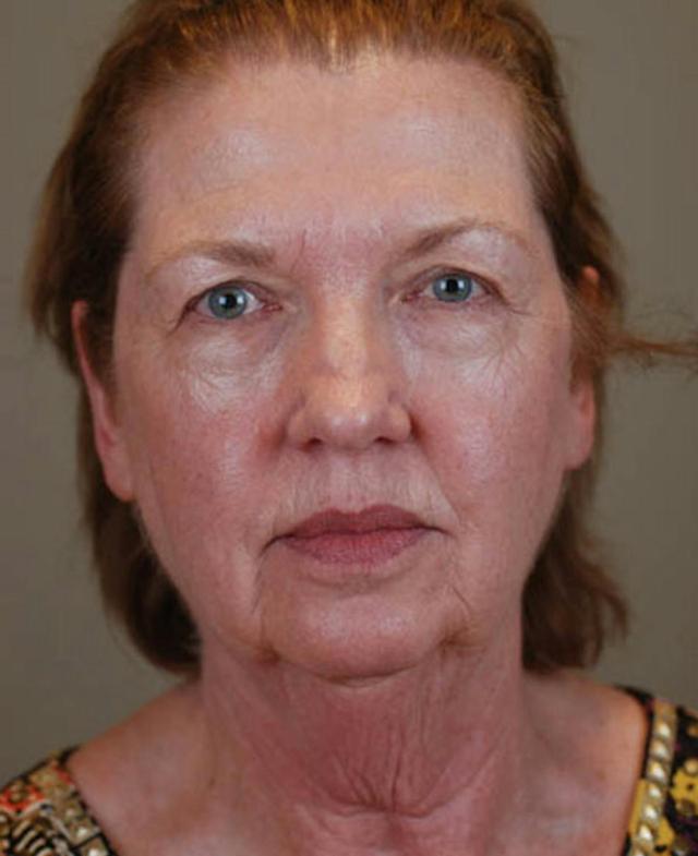 Facelift before at Marcus Medical in Los Angeles, CA