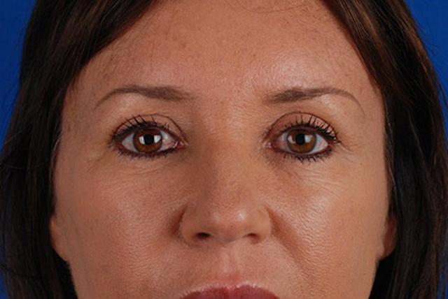 Brow Lift after at Marcus Medical in Los Angeles, CA