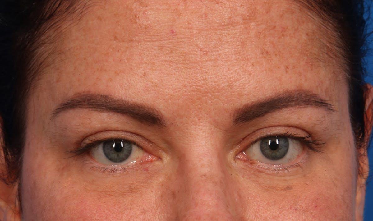 Marcus Medical blepharoplasty after — Los Angeles, CA