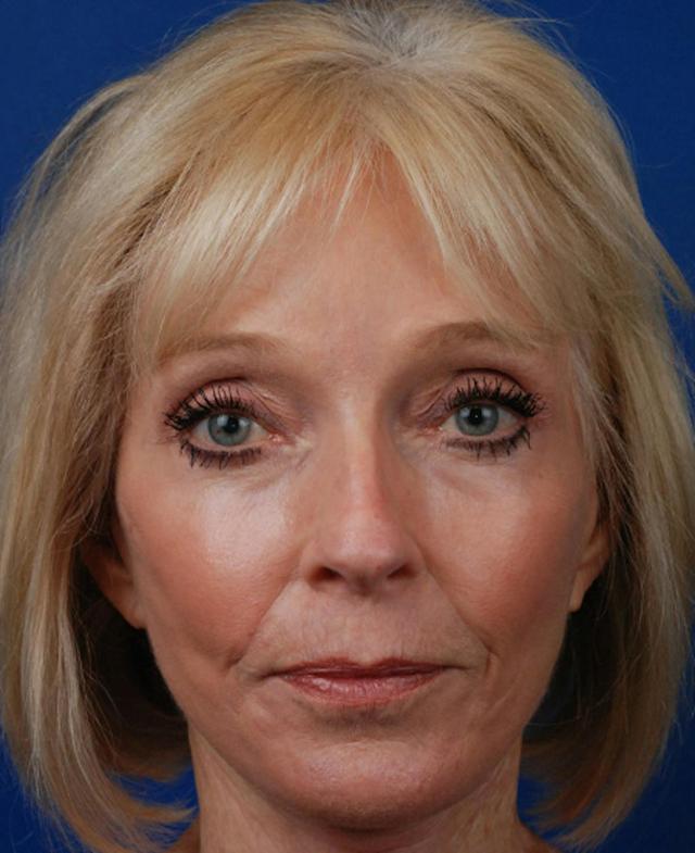 Facelift after at Marcus Medical in Los Angeles, CA