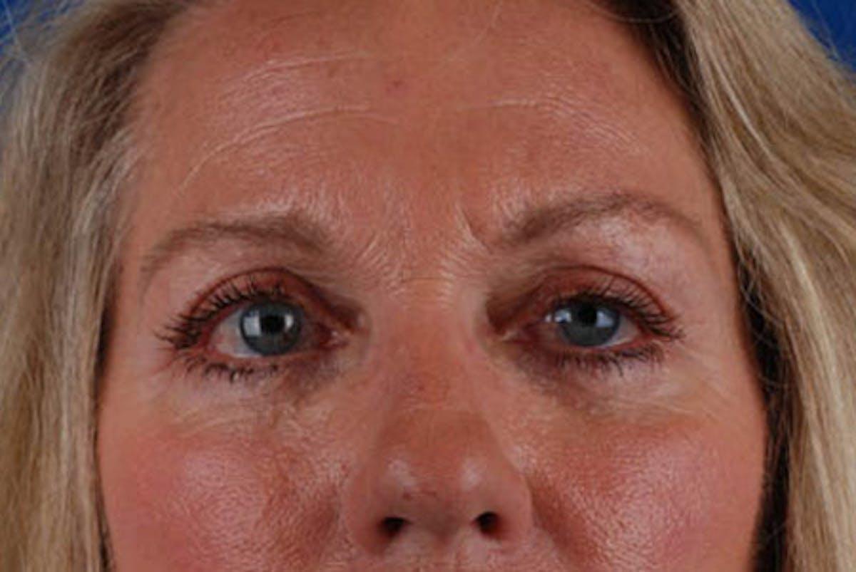 Marcus Medical blepharoplasty after — Los Angeles, CA