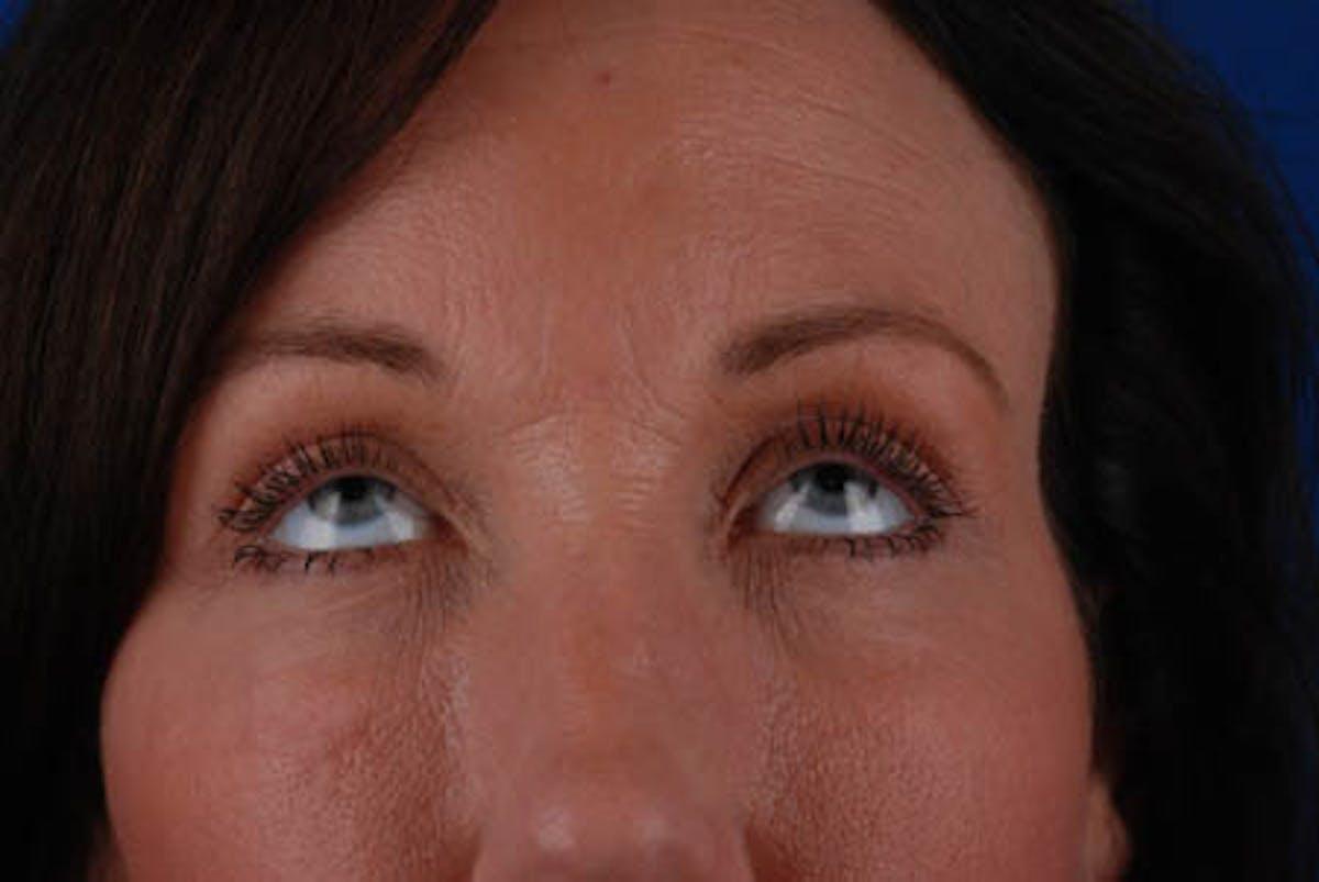 Marcus Medical blepharoplasty after — Los Angeles, CA