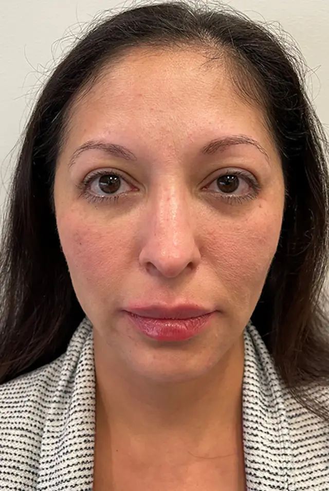 Juvederm after at Marcus Medical in Redondo Beach, CA