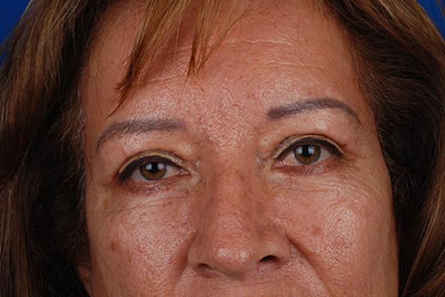Brow Lift after at Marcus Medical in Los Angeles, CA