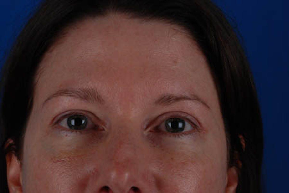 Marcus Medical blepharoplasty after — Los Angeles, CA