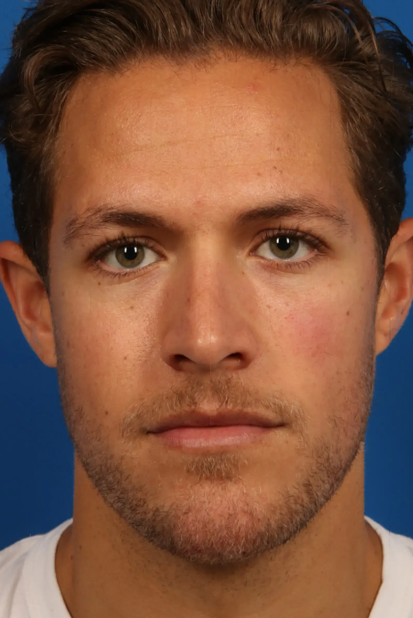 Marcus Medical jawline filler after — Redondo Beach, CA