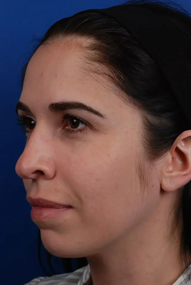 Jawline Filler before at Marcus Medical in Redondo Beach, CA
