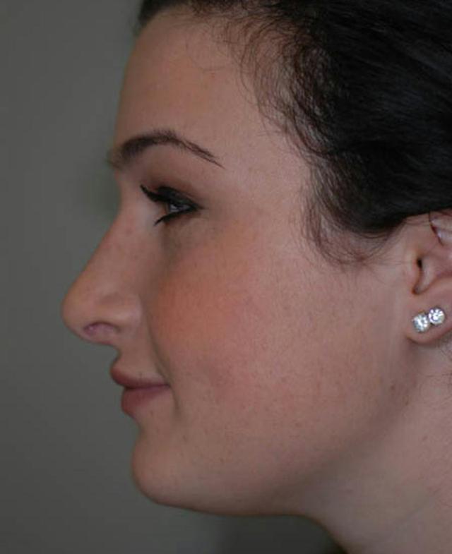 Rhinoplasty after at Marcus Medical in Los Angeles, CA