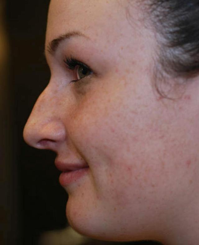 Rhinoplasty before at Marcus Medical in Los Angeles, CA