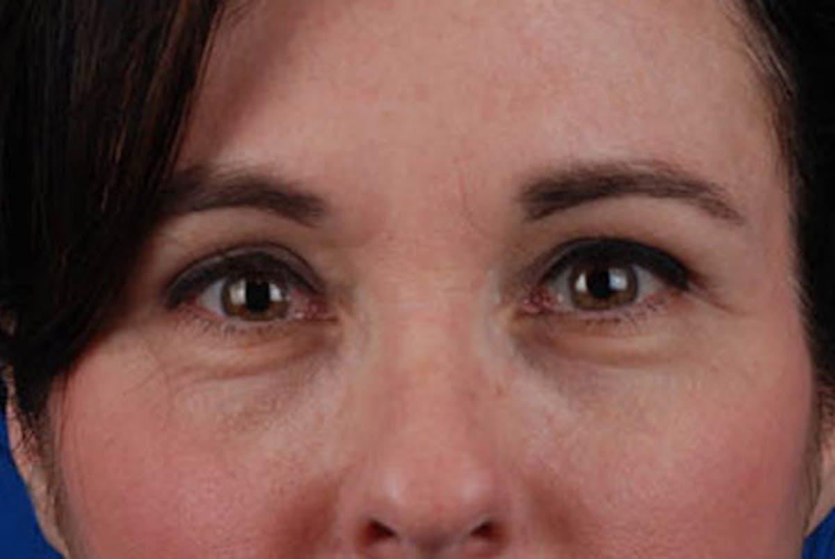 Marcus Medical blepharoplasty after — Los Angeles, CA