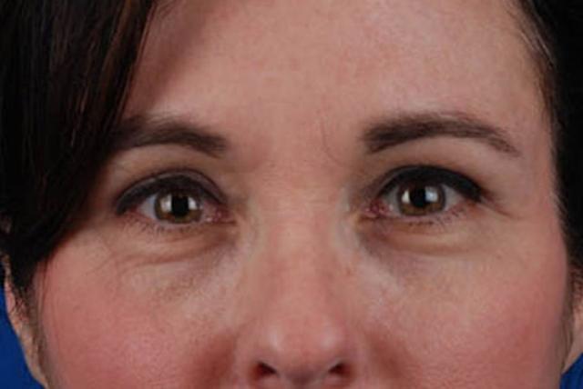 Blepharoplasty after at Marcus Medical in Los Angeles, CA