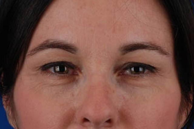 Blepharoplasty before at Marcus Medical in Los Angeles, CA